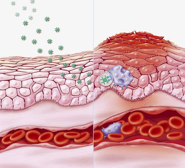 Anti-inflammatory effect of Alpha-Bisabolol
