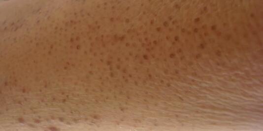 Keratosis pilaris